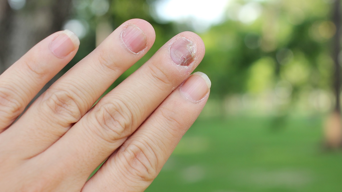 Jornal Bom Dia | Notícias | Notícias: manchas-nas-unhas-podem-ser-sinal -de-problemas-de-saude